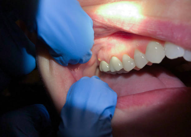 Best Emergency Broken Tooth Repair in Nesconset, NY