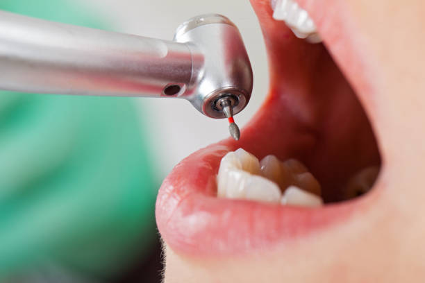 Best Emergency Wisdom Teeth Removal in Nesconset, NY
